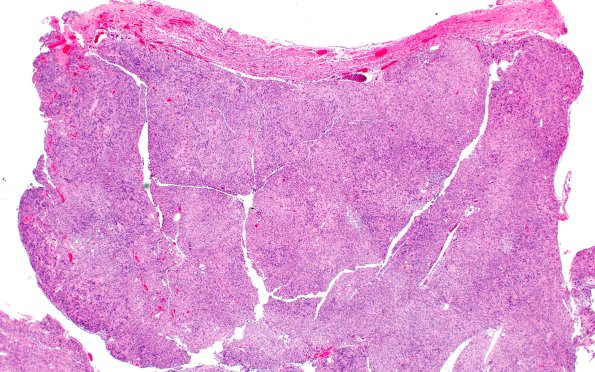 30B1 Schwannoma (Case 30) H&E 2X B
