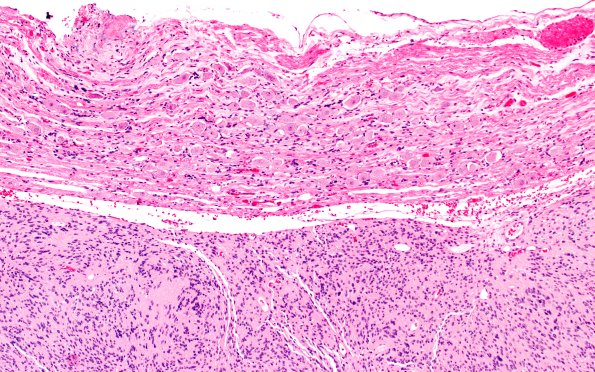 30B2 Schwannoma (Case 30) H&E 10X A