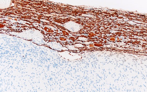 30C2 Schwannoma (Case 30) NF 20X AB