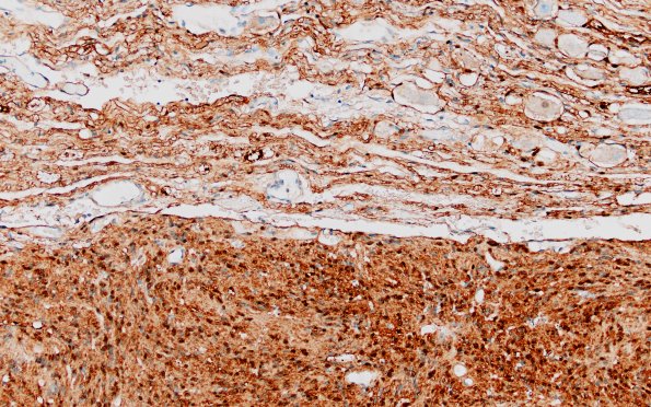 30D2 Schwannoma (Case 30) S100 20X 2