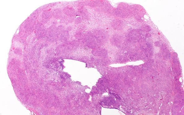 31A1 Schwannoma, whorled NF2 (Case 31) H&E 2X