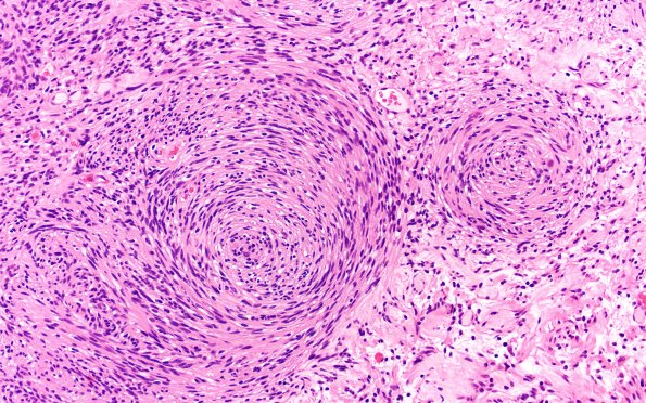 31A3 Schwannoma, whorled NF2 (Case 31) H&E 20X