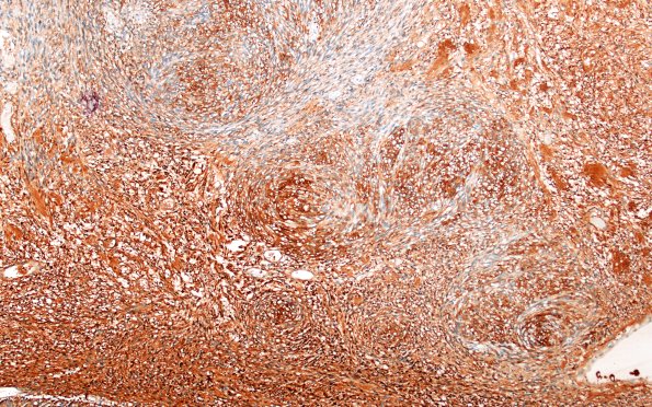 31B2 Schwannoma, whorled NF2 (Case 31) S100 10X