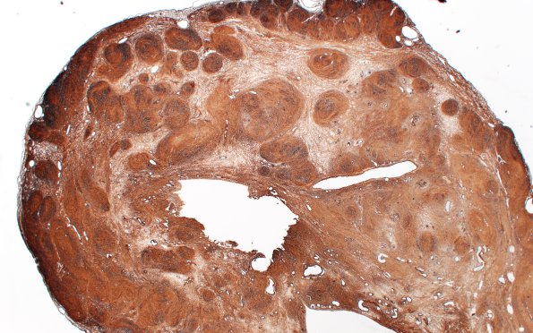 31D1 Schwannoma, whorled NF2 (Case 31) CollIV 2X