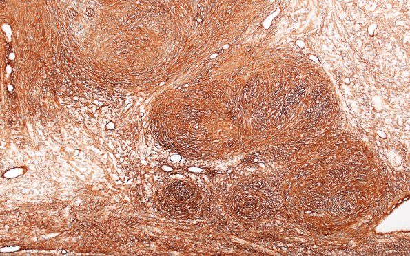31D2 Schwannoma, whorled NF2 (Case 31) CollIV 10X