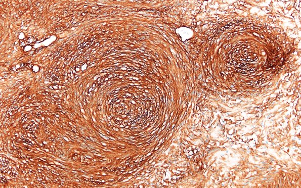 31D3 Schwannoma, whorled NF2 (Case 31) CollIV 20X