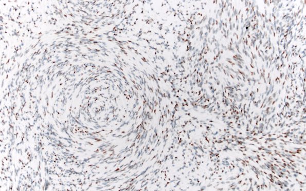 31E1 Schwannoma, whorled NF2 (Case 31) INI1 20X