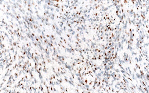 31E2 Schwannoma, whorled NF2 (Case 31) INI1 40X