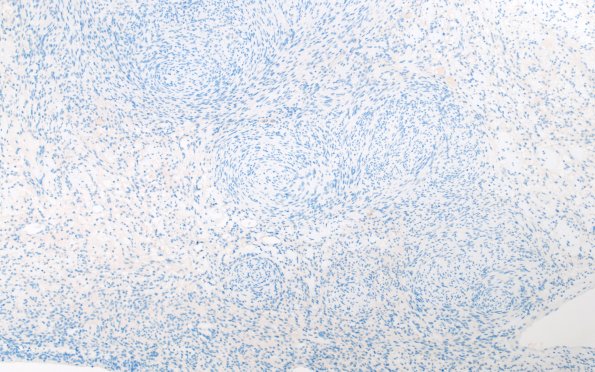 31F1 Schwannoma, whorled NF2 (Case 31) EMA 10X 3