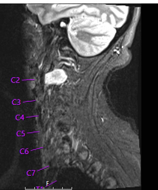 32A1 Schwannoma (Case 32) SGA STIR noC - Copy