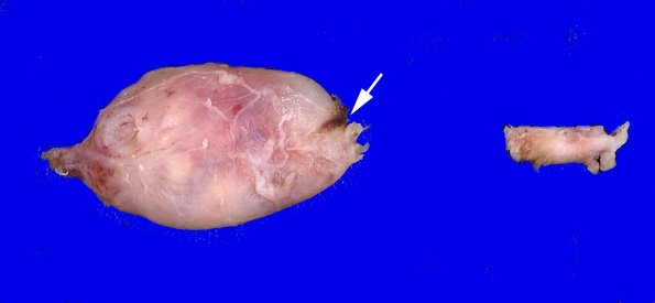 32A2 Schwannoma (Case 32) Gross copy