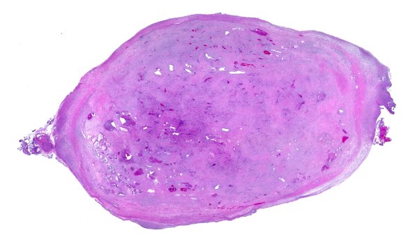 32B1 Schwannoma (Case 32) H&E WM