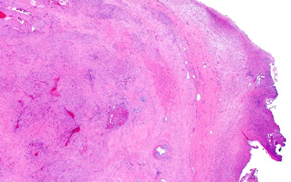 32B2 Schwannoma (Case 32) H&E 2X