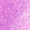 32B3 Schwannoma (Case 32) H&E 20X