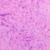 32B4 Schwannoma (Case 32) H&E 10X 4