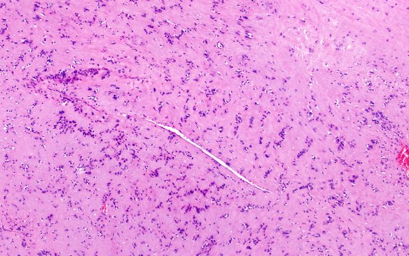 32B4 Schwannoma (Case 32) H&E 10X 4