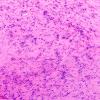 32B5 Schwannoma (Case 32) H&E 10X 3