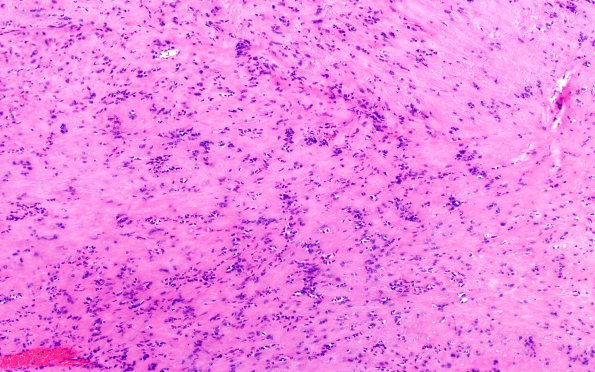 32B5 Schwannoma (Case 32) H&E 10X 3