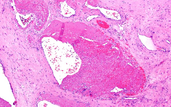 32B6 Schwannoma (Case 32) H&E 10X 2