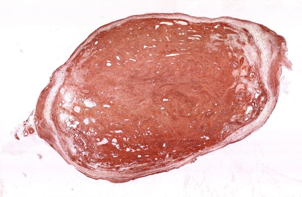 32C1 Schwannoma (Case 32) Coll IV WM