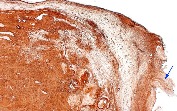 32C2 Schwannoma (Case 32) Coll IV 1 copy