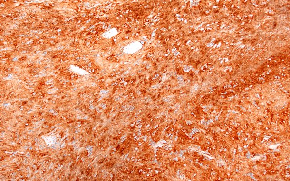 32C3 Schwannoma (Case 32) Coll IV 10X