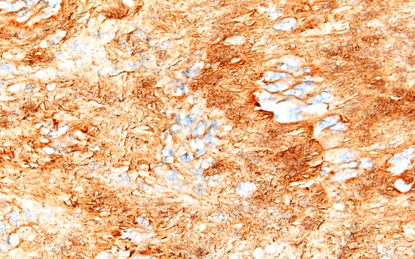 32C4 Schwannoma (Case 32) Coll IV 60X