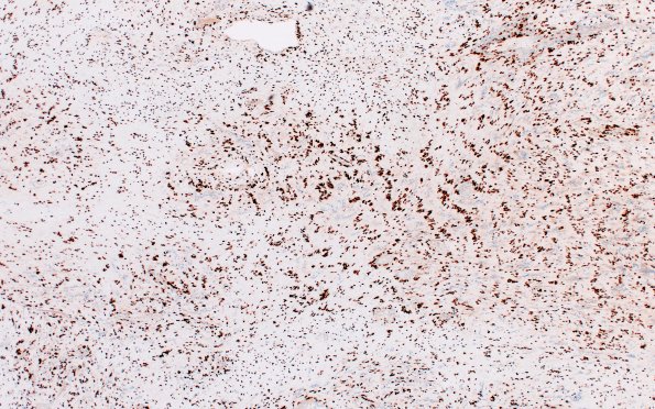 32D2 Schwannoma (Case 32) SOX10 4X 1