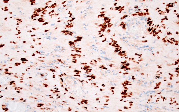 32D3 Schwannoma (Case 32) SOX10 20X 1