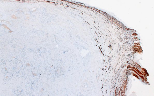 32E1 Schwannoma (Case 32) NF 2X