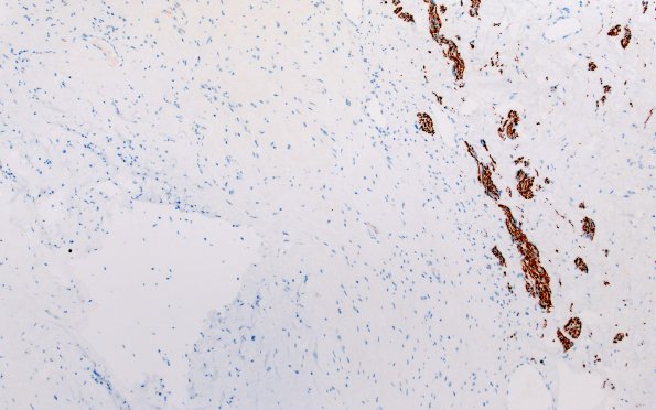 32E2 Schwannoma (Case 32) NF 10X