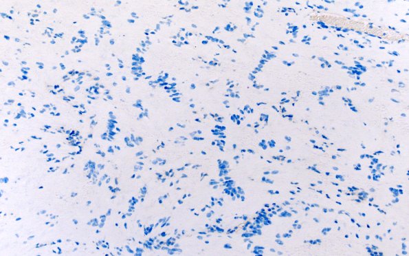 32E3 Schwannoma (Case 32) NF 20X