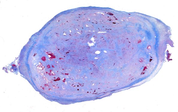 32F1 Schwannoma (Case 32) Trichrome WM