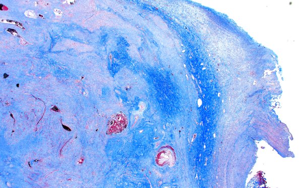 32F2 Schwannoma (Case 32) TRI 2X