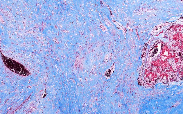 32F3 Schwannoma (Case 32) TRI 10X 2