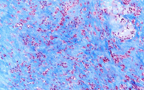 32F4 Schwannoma (Case 32) TRI 20X 2