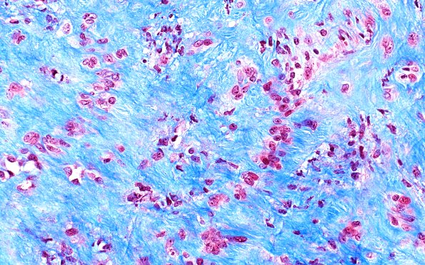 32F5 Schwannoma (Case 32) TRI 40X 2