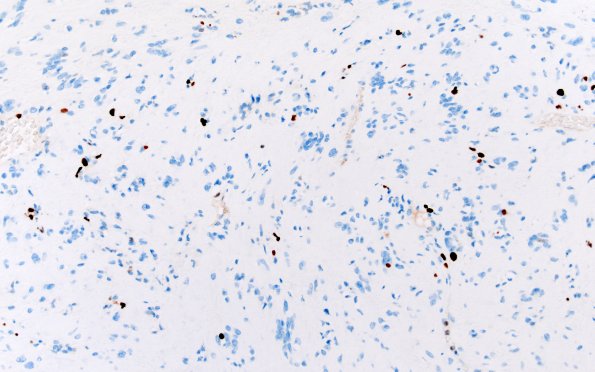 32G Schwannoma (Case 32) Ki67 20X 1