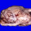 3B1 Schwannoma (Case 3) _1