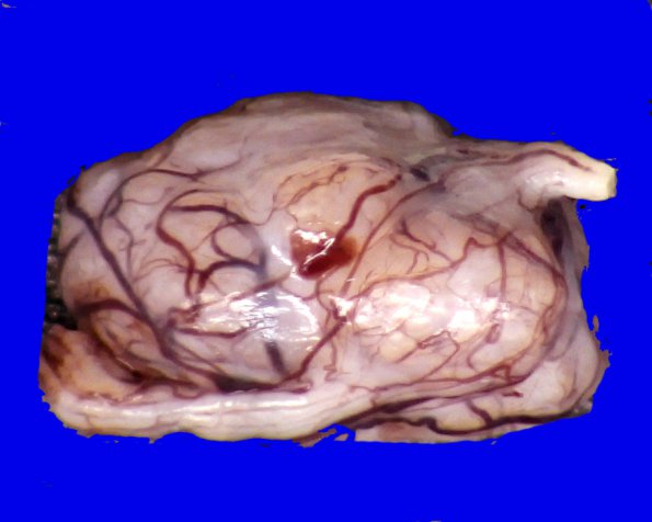 3B1 Schwannoma (Case 3) _1