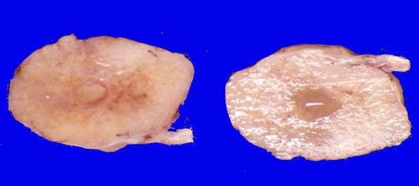 3B2 Schwannoma (Case 3) _2