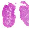 3C1 Schwannoma (Case 3) H&E WM