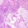 3C3 Schwannoma (Case 3) H&E 3.jpg