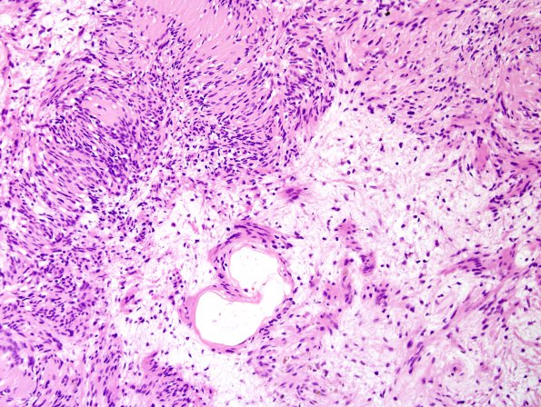 3C3 Schwannoma (Case 3) H&E 3.jpg