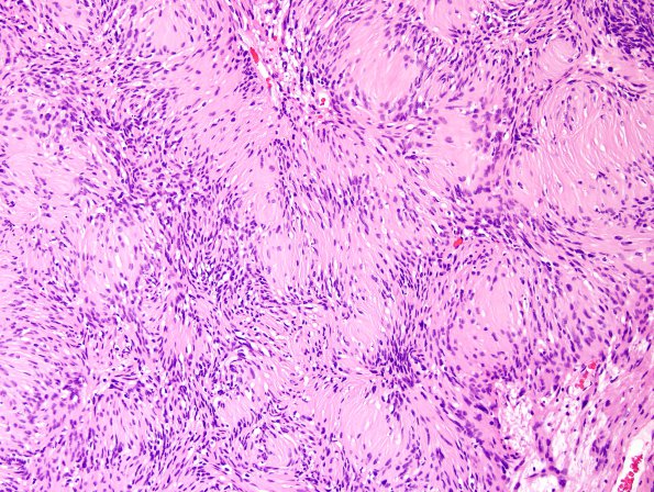 3C4 Schwannoma (Case 3) H&E 2.jpg