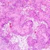 3C5 Schwannoma (Case 3) H&E 10X