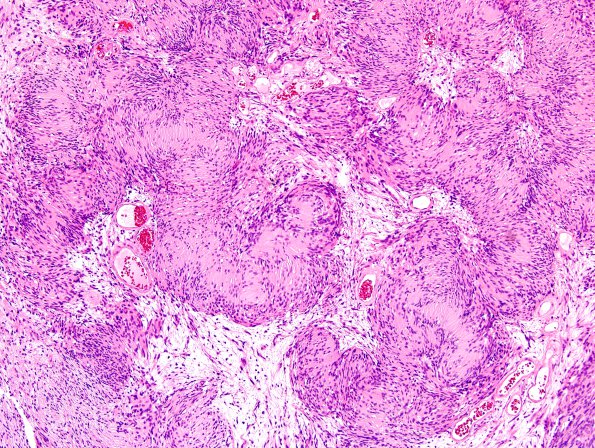 3C5 Schwannoma (Case 3) H&E 10X