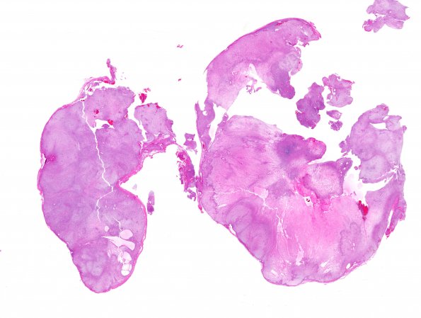 4A1 Schwannoma (Case 4) H&E WM