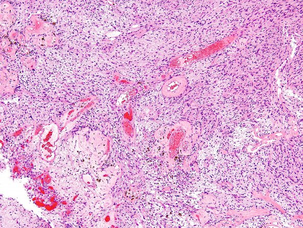 4A2 Schwannoma (Case 4A) H&E 2