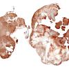 4C Schwannoma (Case 4) CollIV WM